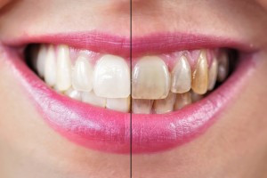 Почему зубы темнеют?